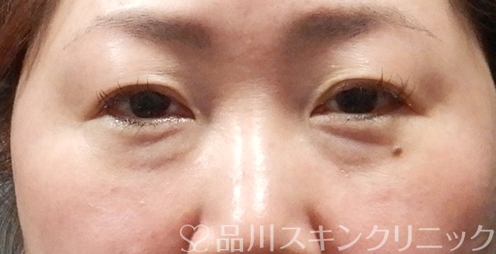 症例NO.63952のBEFORE写真