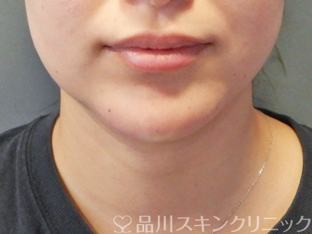症例NO.65569のAFTER写真