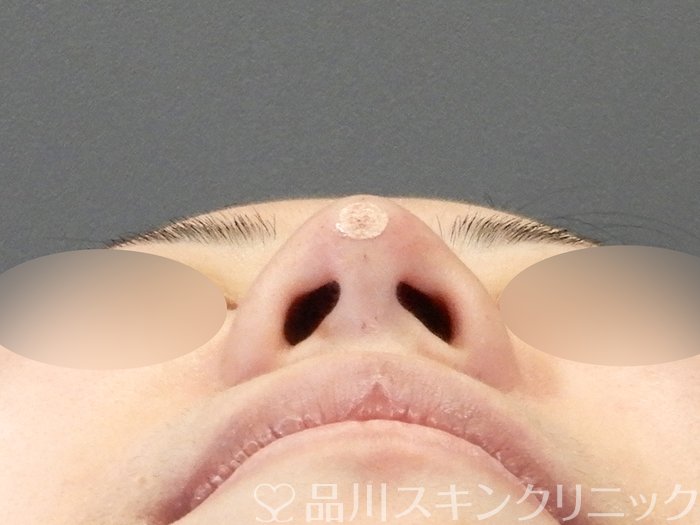 症例NO.64192のAFTER写真