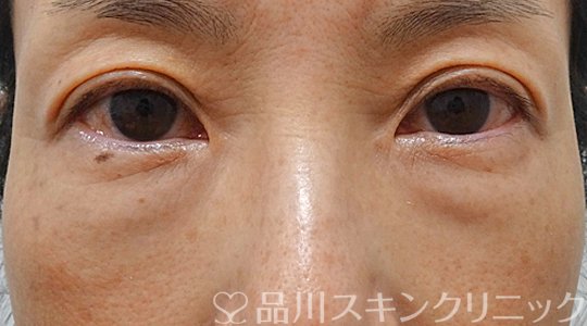 症例NO.69111のBEFORE写真
