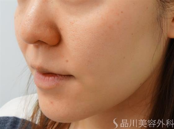 症例NO.32173のAFTER写真
