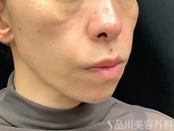 症例NO.67760のBEFORE写真