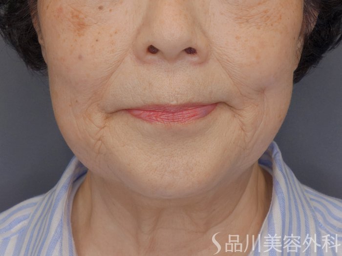 症例NO.71810のBEFORE写真