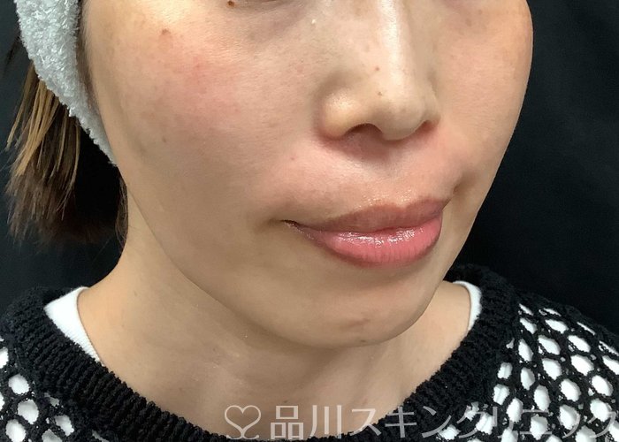 症例NO.71036のBEFORE写真