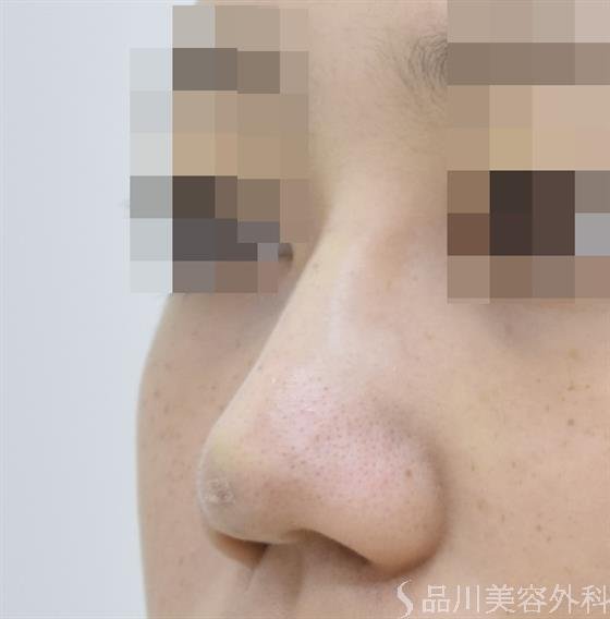 症例NO.44115のAFTER写真