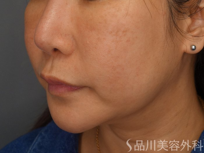 症例NO.75335のBEFORE写真