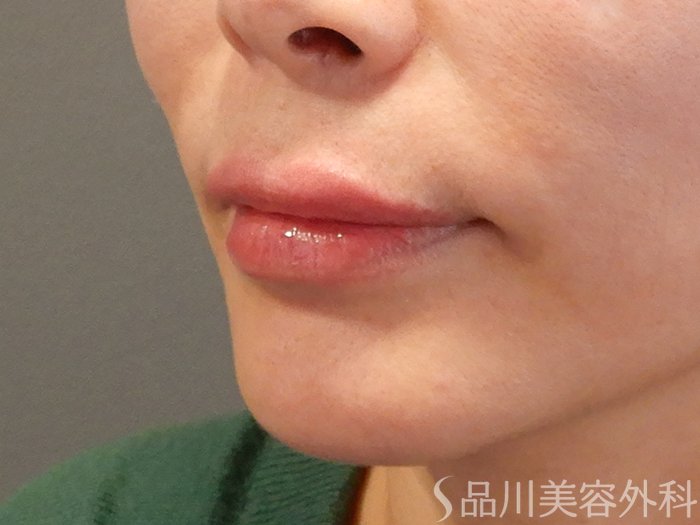 症例NO.69690のAFTER写真