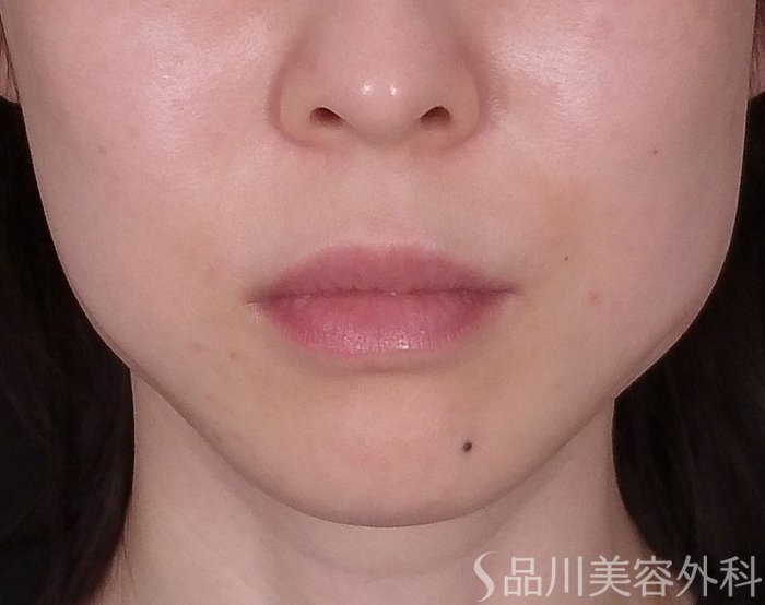 症例NO.69720のAFTER写真