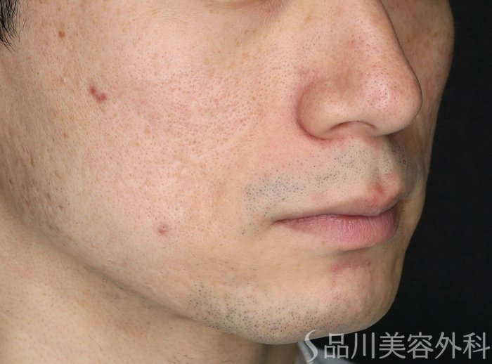 症例NO.65413のBEFORE写真