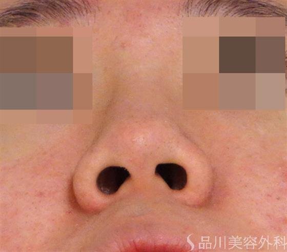 症例NO.40038のBEFORE写真