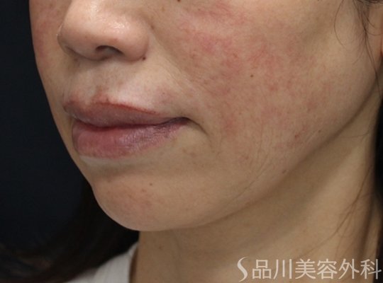 症例NO.75021のBEFORE写真