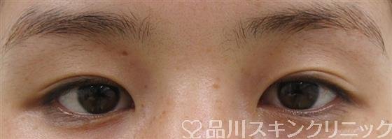 症例NO.38812のBEFORE写真