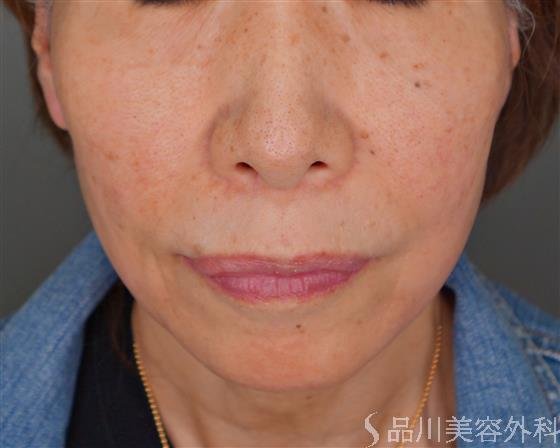 症例NO.54675のBEFORE写真