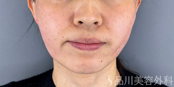 症例NO.73171のAFTER写真