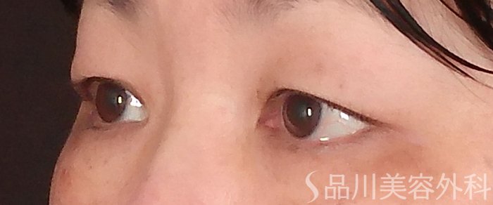 症例NO.71348のBEFORE写真