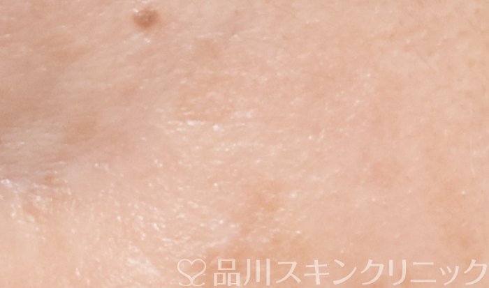 症例NO.64542のAFTER写真
