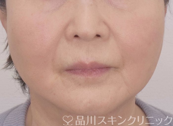 症例NO.69886のAFTER写真