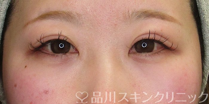 症例NO.73328のBEFORE写真