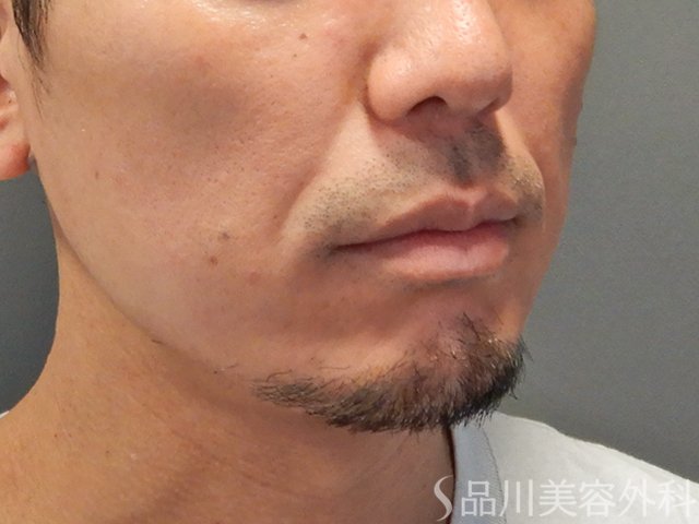 症例NO.73372のBEFORE写真