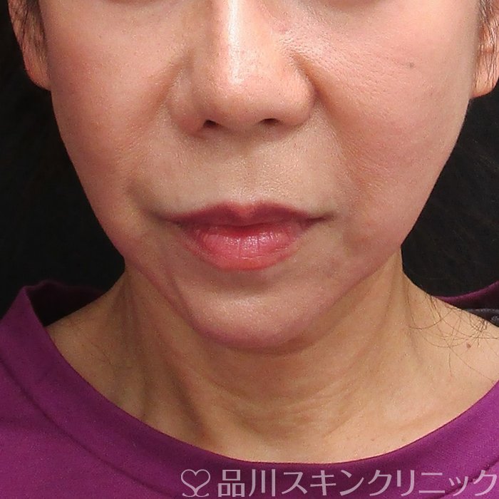 症例NO.72773のBEFORE写真