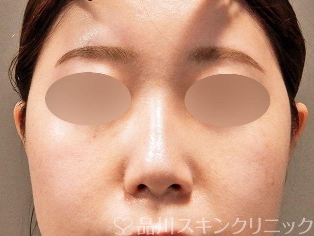 症例NO.69518のAFTER写真