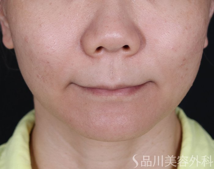 症例NO.71163のBEFORE写真