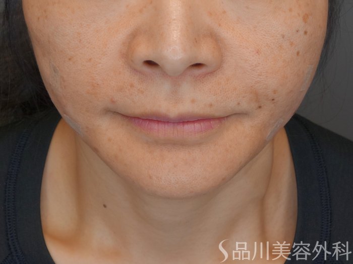 症例NO.68181のAFTER写真