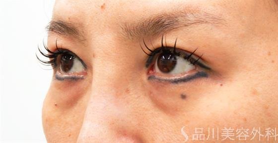 症例NO.53019のBEFORE写真