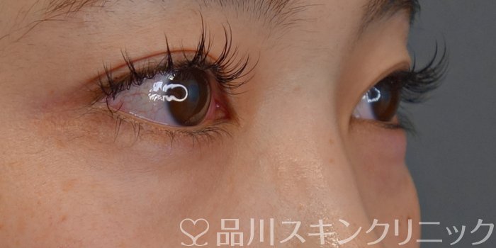 症例NO.72532のBEFORE写真