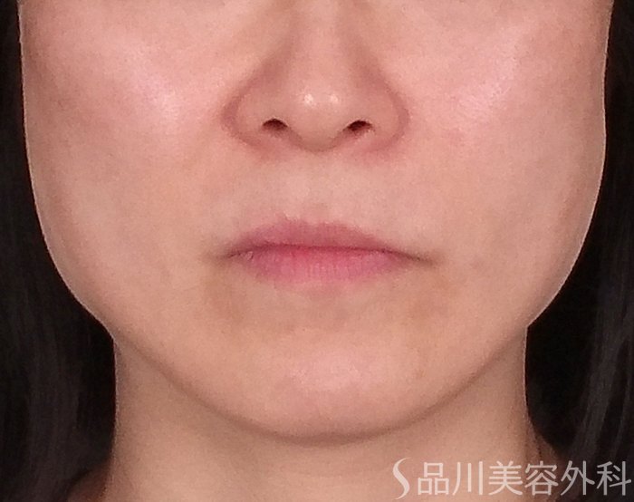 症例NO.70153のAFTER写真