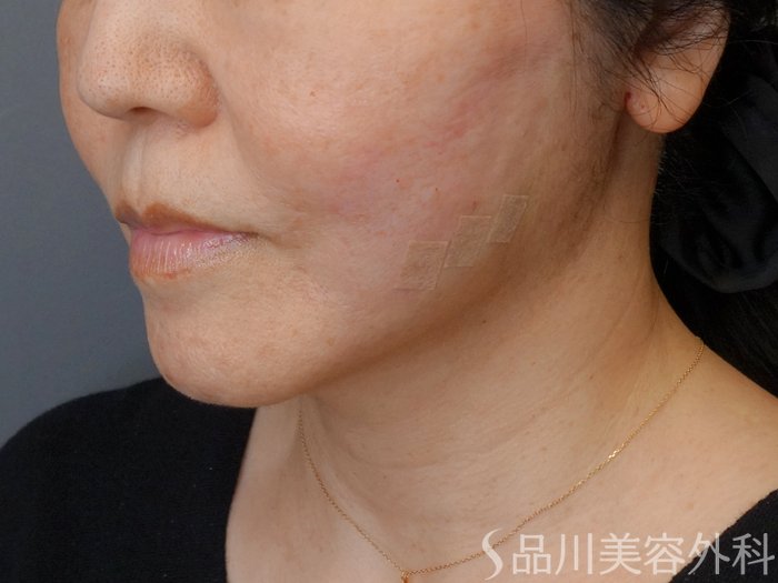 症例NO.72942のAFTER写真