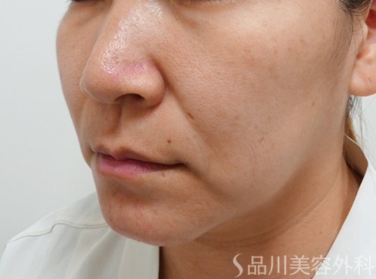 症例NO.72846のBEFORE写真