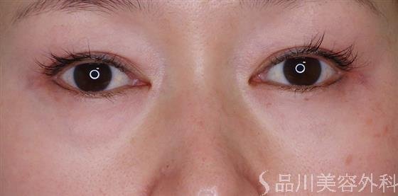 症例NO.49500のBEFORE写真