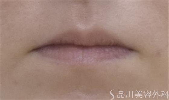 症例NO.52004のBEFORE写真