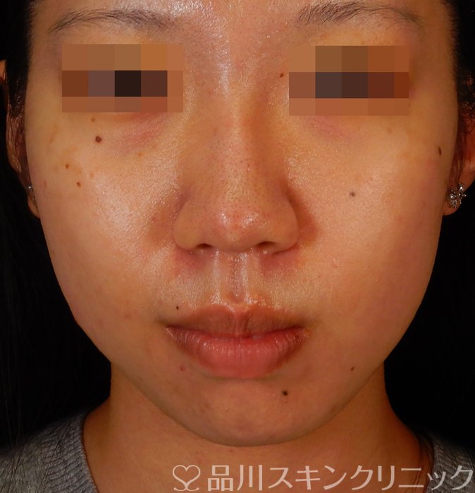 症例NO.66551のBEFORE写真