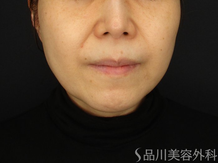 症例NO.69538のAFTER写真