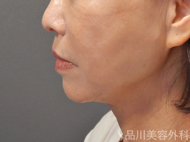 症例NO.72327のAFTER写真