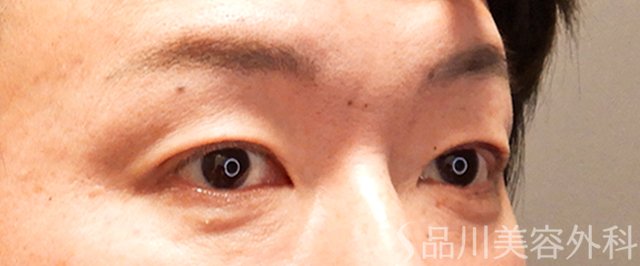 症例NO.69298のAFTER写真