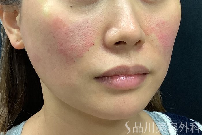 症例NO.71581のAFTER写真