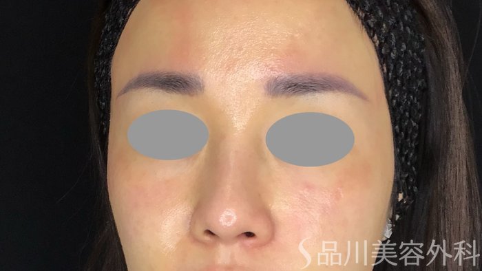 症例NO.67924のBEFORE写真
