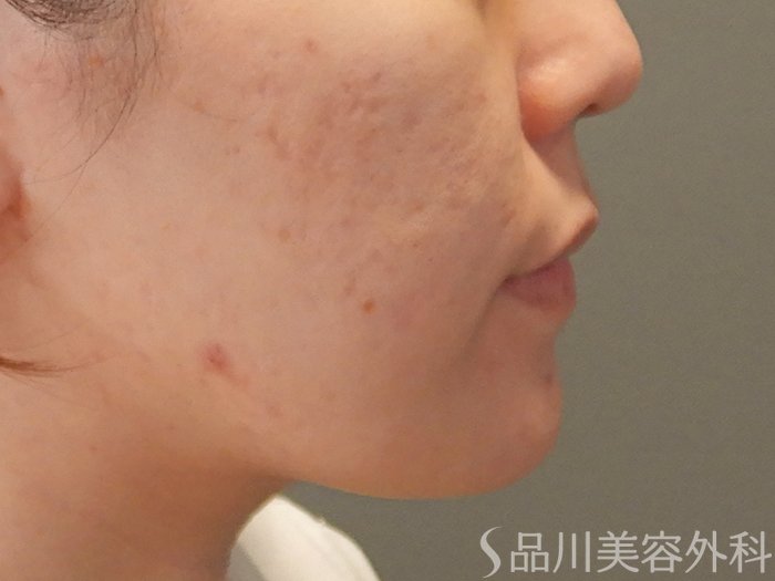 症例NO.70637のBEFORE写真