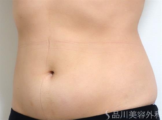 症例NO.35165のAFTER写真