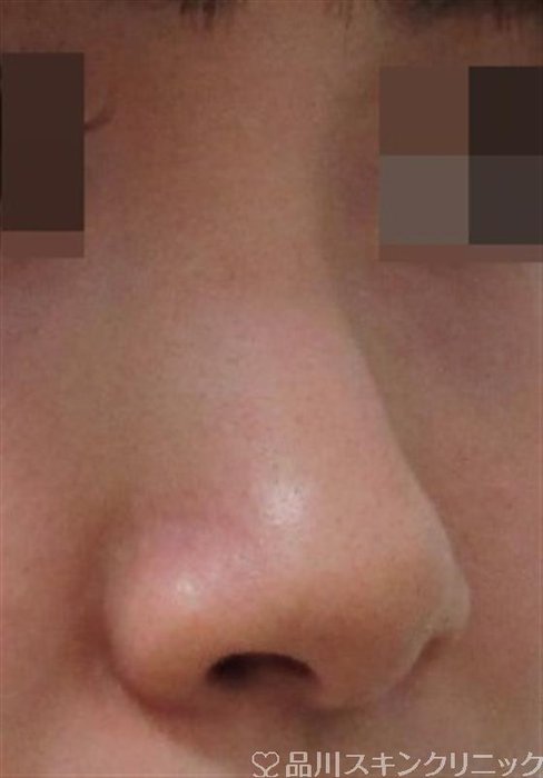 症例NO.32232のBEFORE写真