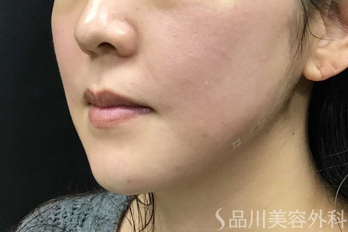 症例NO.63013のAFTER写真