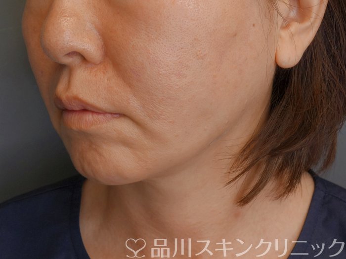 症例NO.71298のAFTER写真