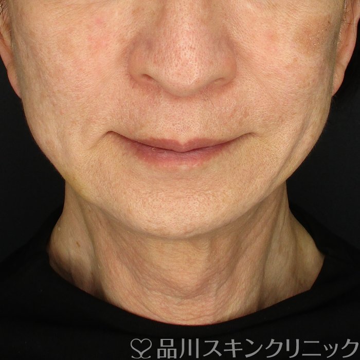 症例NO.74622のAFTER写真