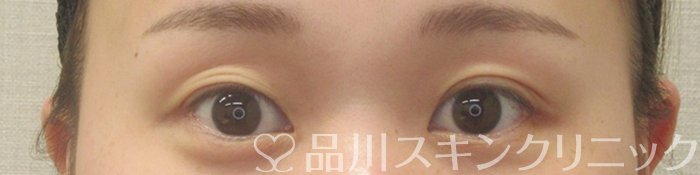 症例NO.73938のBEFORE写真