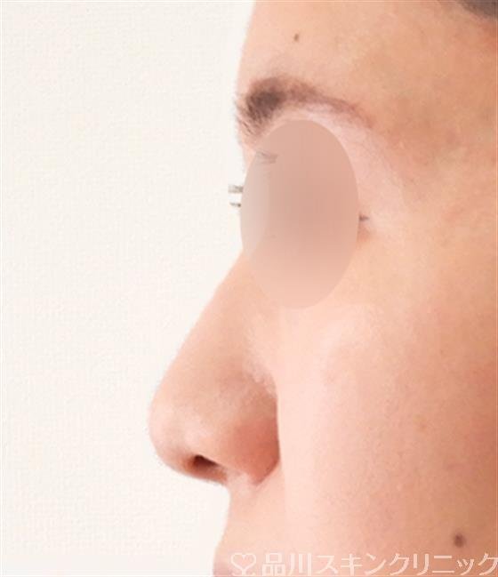 症例NO.60407のAFTER写真