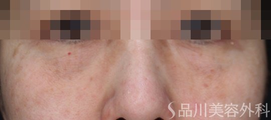 症例NO.70515のBEFORE写真