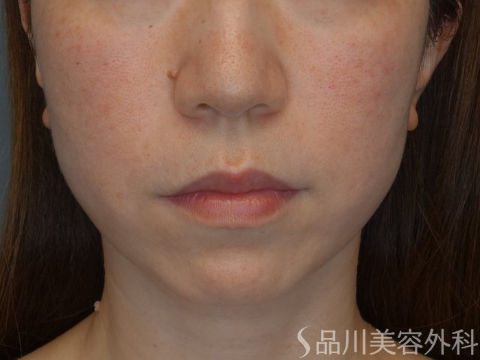 症例NO.73854のBEFORE写真
